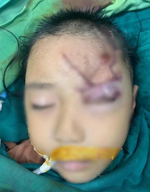 be gai 5 tuoi bi ton thuong vung mat nghiem trong do bi cho can 2 be gai 5 tuoi bi ton thuong vung mat nghiem trong do bi cho can 2
