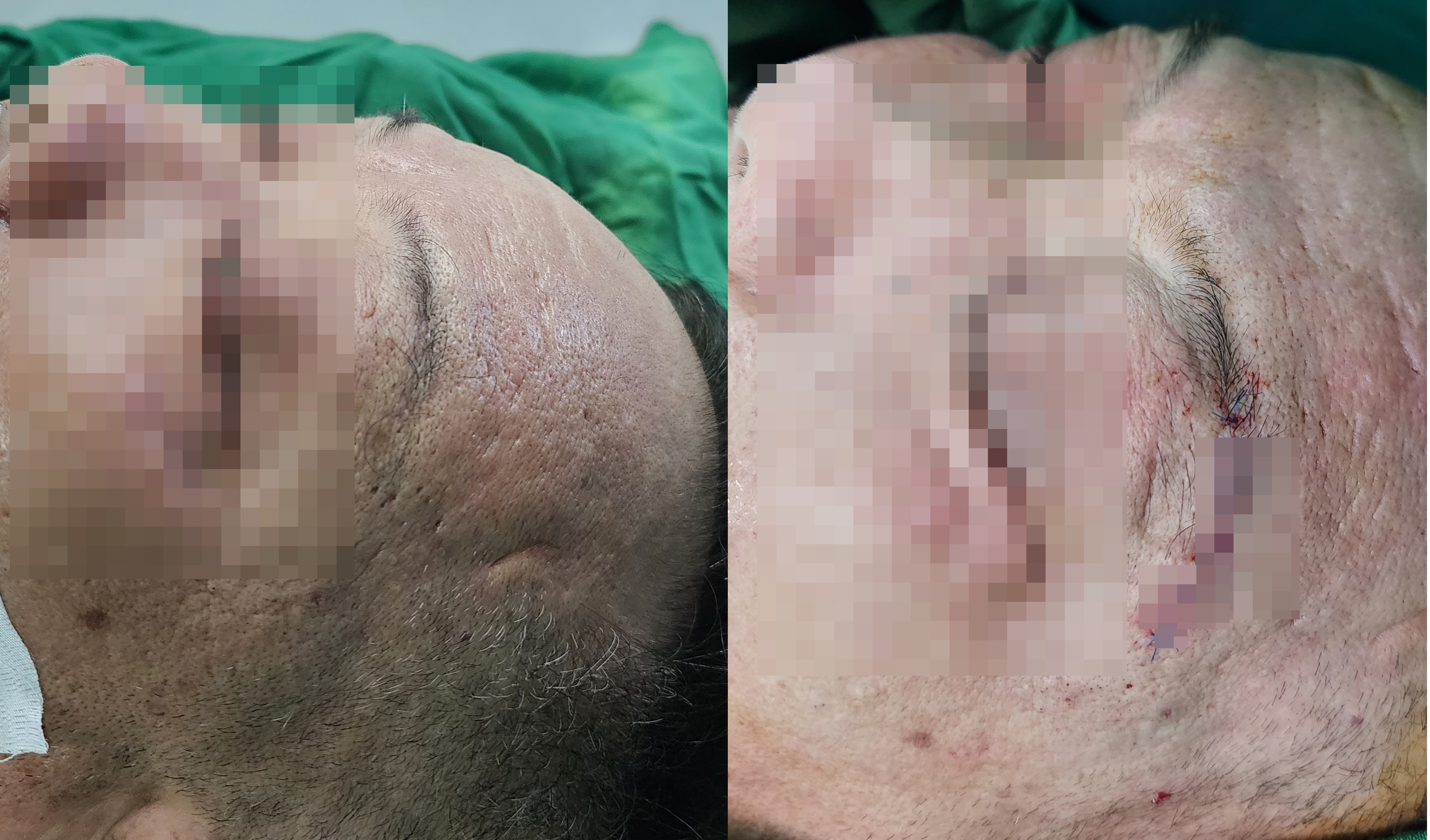 mat nham khong kin nhin mo nguoi dan ong bat ngo phat hien khoi u trong hoc mat2