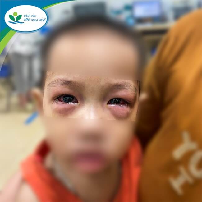 bac si canh bao dich dau mat do lay lan nhanh nhieu tre bien chung nang 2 bac si canh bao dich dau mat do lay lan nhanh nhieu tre bien chung nang 2