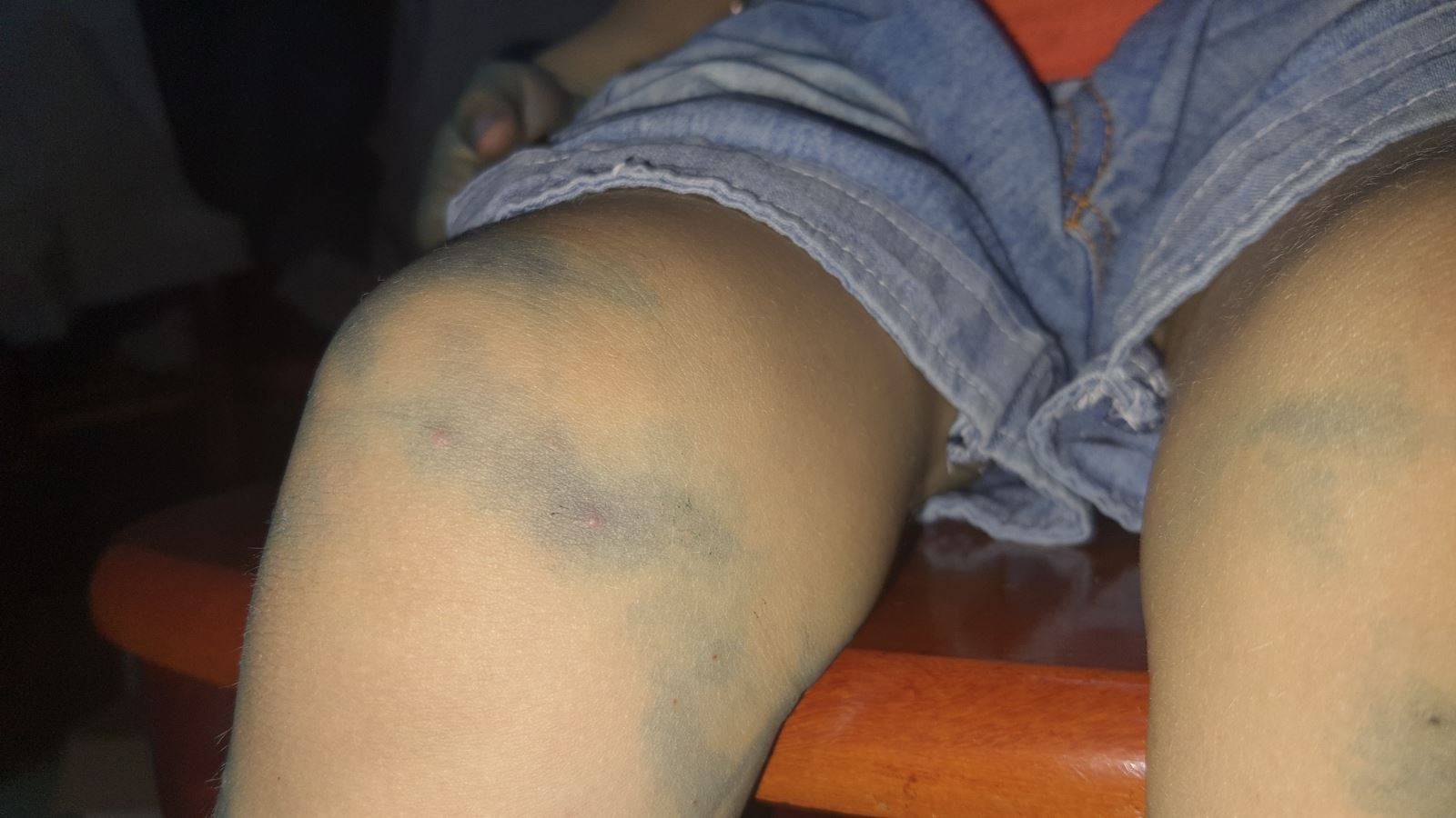 dak lak ghi nhan truong hop thu 2 do tay chan mieng 1