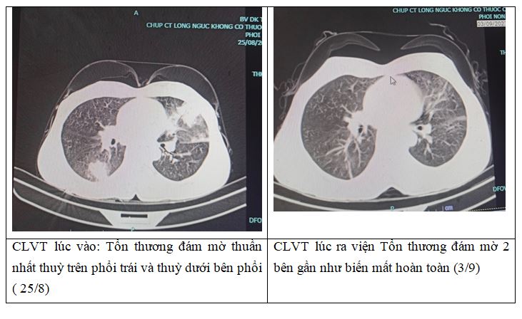 mac viem phoi hiem gap do duong tinh voi giun dua cho meo 1 mac viem phoi hiem gap do duong tinh voi giun dua cho meo 1