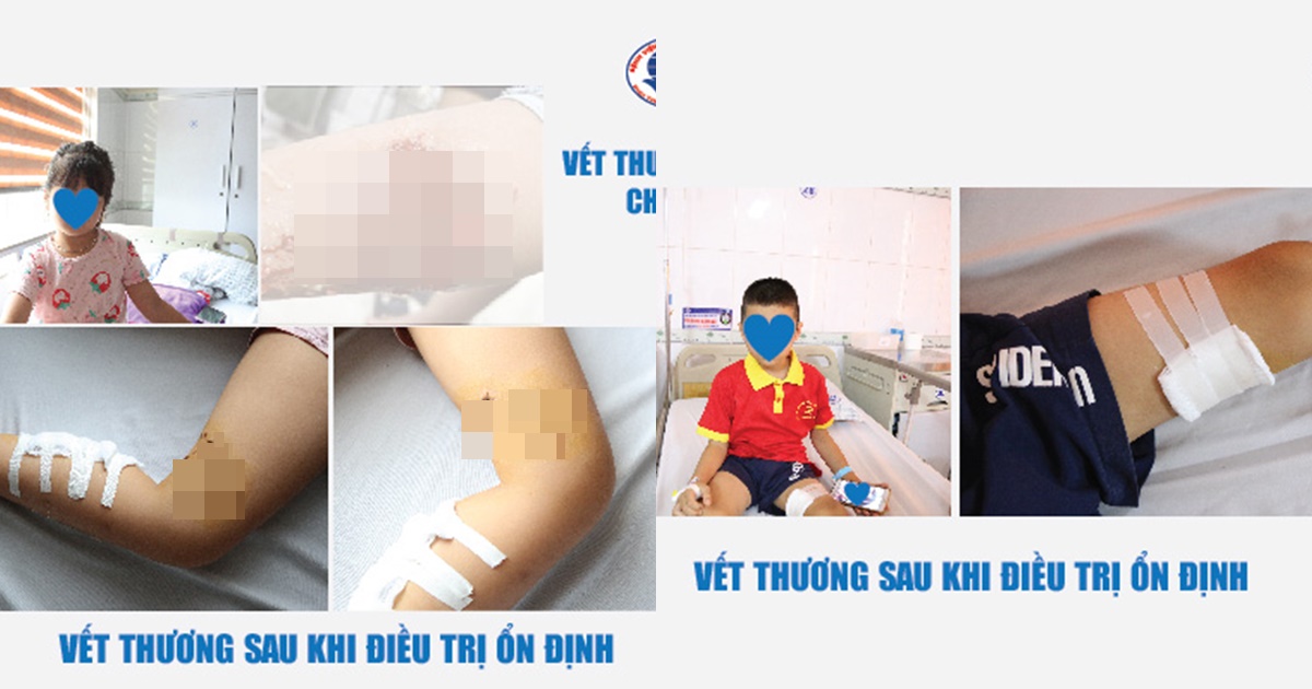 bi cho hang xom can luc dang choi hai chau be dieu tri ca thang vet thuong chua lien 5 bi cho hang xom can luc dang choi hai chau be dieu tri ca thang vet thuong chua lien 5