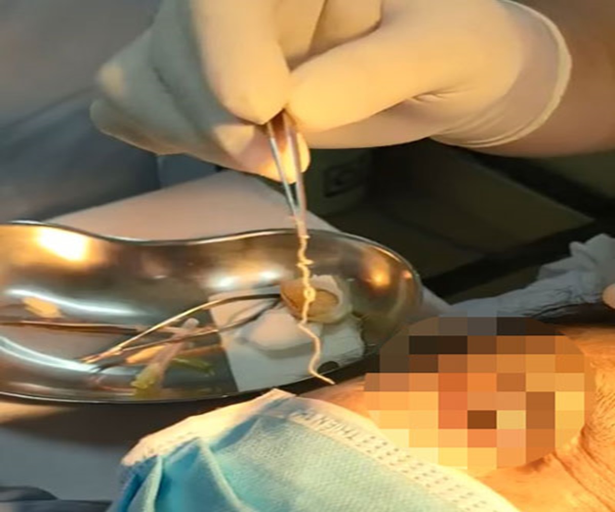 phat hien giun dai 10cm song trong mat nguoi phu nu 1 phat hien giun dai 10cm song trong mat nguoi phu nu 1