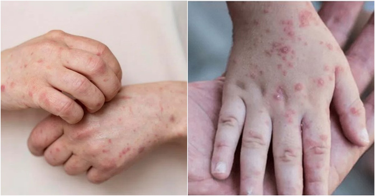 viet nam ghi nhan 56 truong hop nhiem benh dau mua khi bo y te canh bao mam benh da xam nhap trong cong dong 6