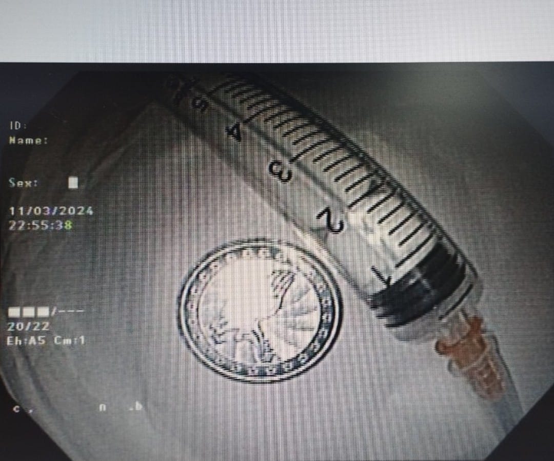 benh nhi 6 tuoi bat ngo nuot dong xu vao thuc quan khi dang choi voi ban1