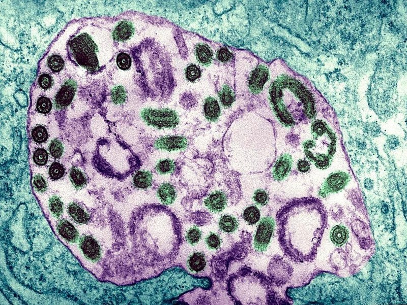 bv cho ray cach ly nhu the nao doi voi cac ca nghi nhiem virus marburg 3 bv cho ray cach ly nhu the nao doi voi cac ca nghi nhiem virus marburg 3
