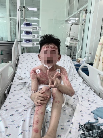 benh nhi mac trieu chung hiem gap sau khi an cua 2 ngay1 benh nhi mac trieu chung hiem gap sau khi an cua 2 ngay1