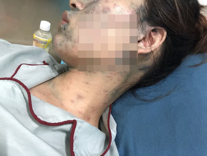 benh nhan mang thai 22 tuan phai nhap vien do mac thuy dau boi nhiem1 benh nhan mang thai 22 tuan phai nhap vien do mac thuy dau boi nhiem1