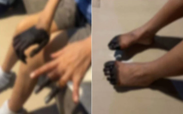 thai lan nu benh nhan nhap vien dieu tri tieu chay nhung lai bi cat cut gan het ngon tay chan1 thai lan nu benh nhan nhap vien dieu tri tieu chay nhung lai bi cat cut gan het ngon tay chan1