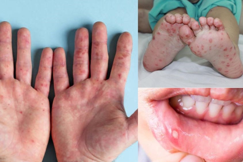 nhung bien phap phong chong tay chan mieng truoc tinh hinh dich dien bien phuc tap1 nhung bien phap phong chong tay chan mieng truoc tinh hinh dich dien bien phuc tap1