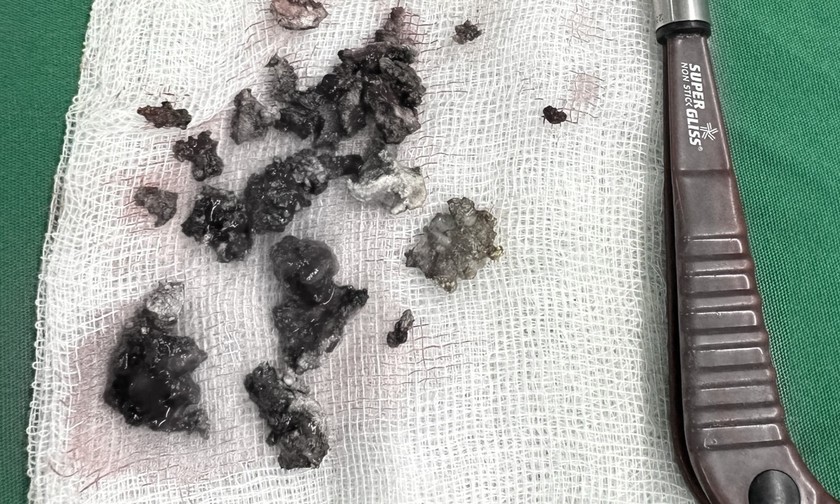 lay thanh cong khoi soi co kich thuoc lon trong mui nguoi phu nu suot 30 nam1 lay thanh cong khoi soi co kich thuoc lon trong mui nguoi phu nu suot 30 nam1