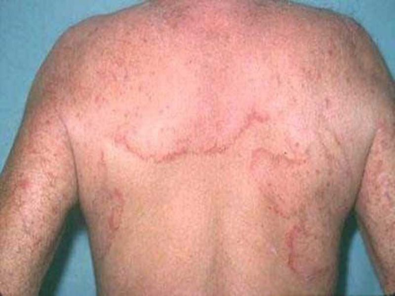 nhiem au trung giun dua vi thoi quen thuong gap o nguoi hay nuoi thu cung3 nhiem au trung giun dua vi thoi quen thuong gap o nguoi hay nuoi thu cung3