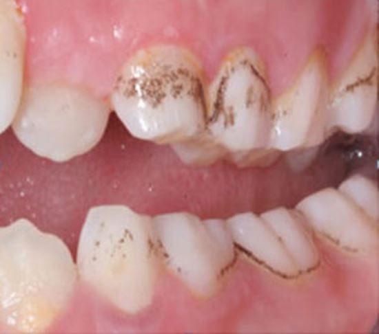 nhung dau hieu canh bao sau rang nguyen nhan va cach phong tranh sau rang 11 nhung dau hieu canh bao sau rang nguyen nhan va cach phong tranh sau rang 11