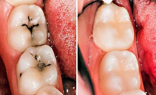 nhung dau hieu canh bao sau rang nguyen nhan va cach phong tranh sau rang 6 nhung dau hieu canh bao sau rang nguyen nhan va cach phong tranh sau rang 6