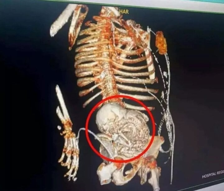 cu ba u80 qua doi sau khi loai bo bao thai bi voi hoa trong co the suot 56 nam1 cu ba u80 qua doi sau khi loai bo bao thai bi voi hoa trong co the suot 56 nam1