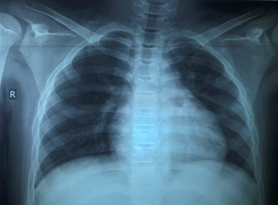 dieu tri thanh cong be trai 13 tuoi mac covid 19 ton thuong phoi nang dspl 2 dieu tri thanh cong be trai 13 tuoi mac covid 19 ton thuong phoi nang dspl 2