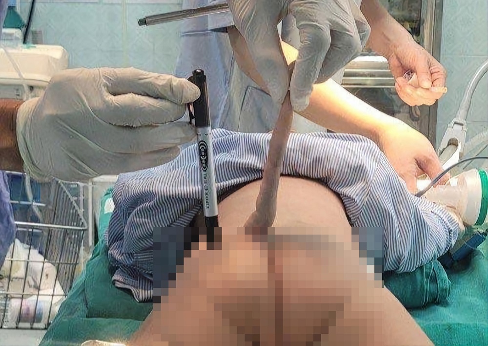 phau thuat thanh cong duoi di tat dai 14cm cho mot benh nhi 4 thang tuoi1