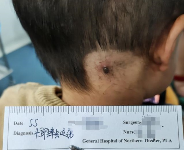 phat hien cuc thit du den thui sau gay con me lam ngay 3 viec bac si biet chuyen khen nuc no