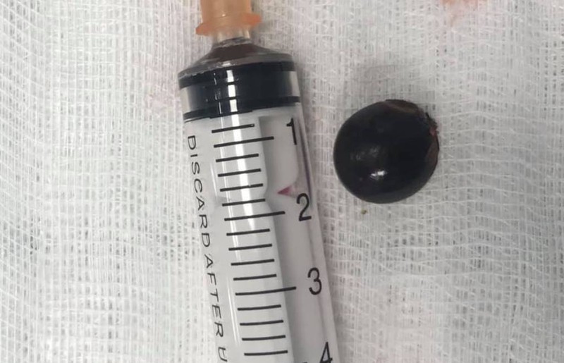 tin tuc doi song ngay 177 gap thanh cong hat nhan trong phoi be gai 12 tuoi1 tin tuc doi song ngay 177 gap thanh cong hat nhan trong phoi be gai 12 tuoi1