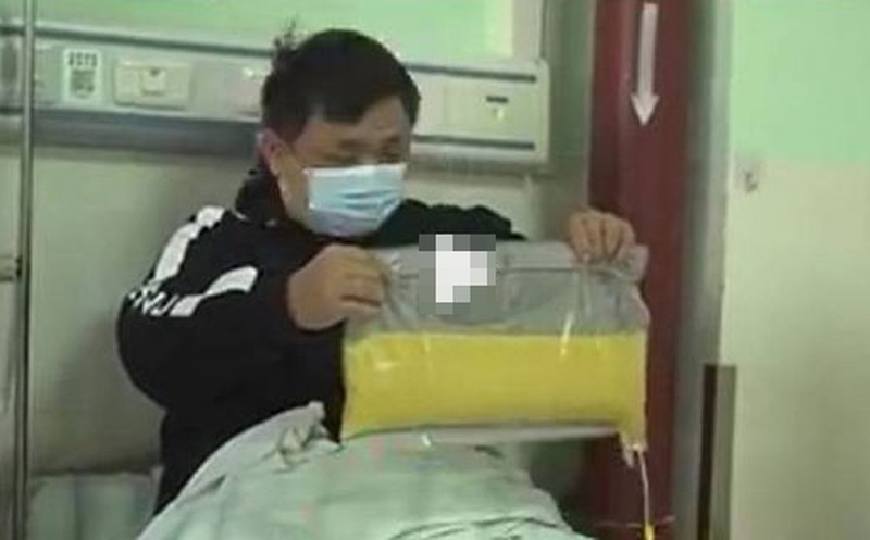nguoi dan ong loc duoc 2 lit mo thua tu mau nhin thanh qua tren taybac si ma khiep dam nguoi dan ong loc duoc 2 lit mo thua tu mau nhin thanh qua tren taybac si ma khiep dam