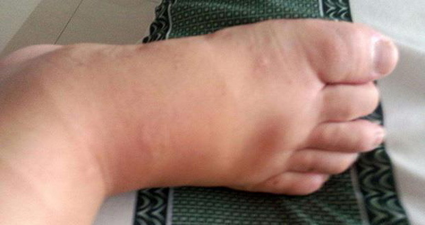 cu ong 68 tuoi phai cat cut ngon chan nguyen nhan khien nhieu nguoi giat minh