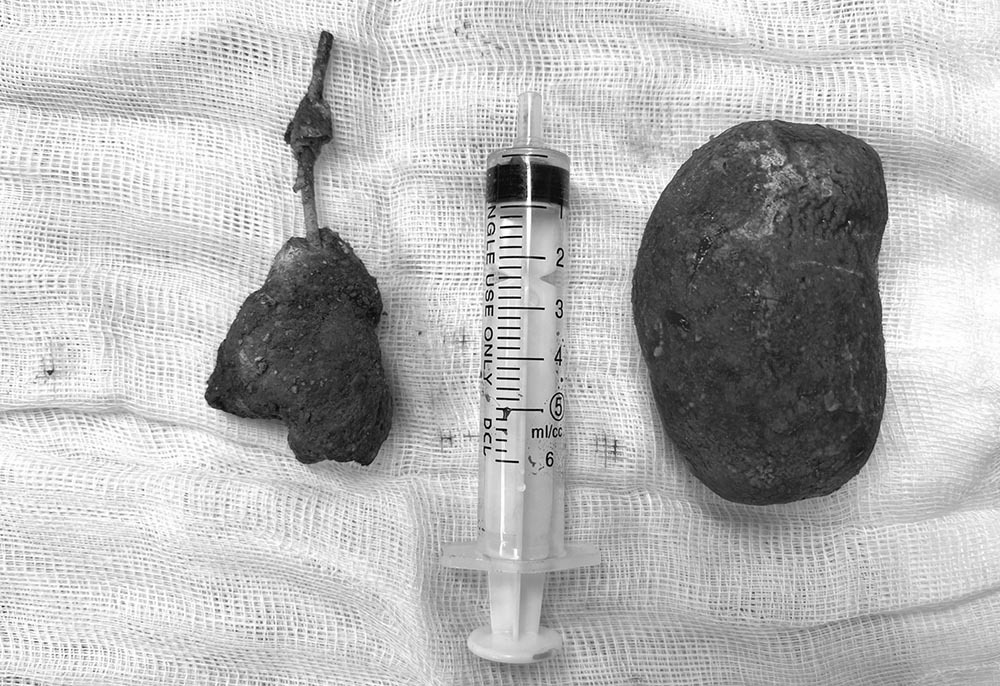 tin tuc doi song ngay 263 phau thuat lay vien soi khung trong bang quang thanh nien 27 tuoi1