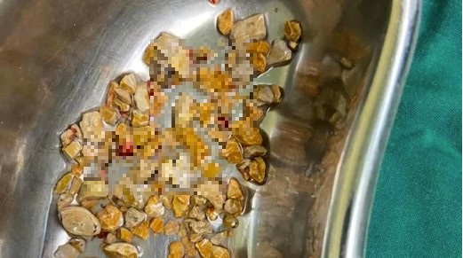 tin tuc doi song ngay 235 nguoi phu nu 10 nam bi lo loet vung cung cut31