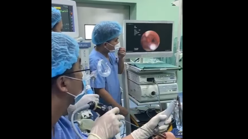 vat rung dai 8cm song trong duong tho cua be 6 tuoi suot 1 thang