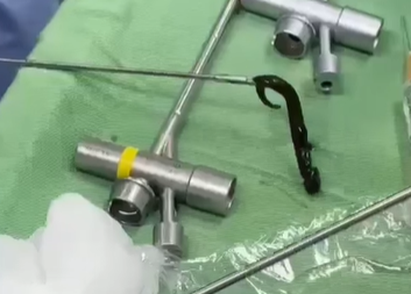 vat rung dai 8cm song trong duong tho cua be 6 tuoi suot 1 thang1