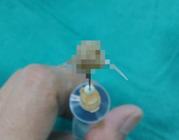 manh xuong ca sac nhon mac trong duong tho cua benh nhi 2 tuoi manh xuong ca sac nhon mac trong duong tho cua benh nhi 2 tuoi