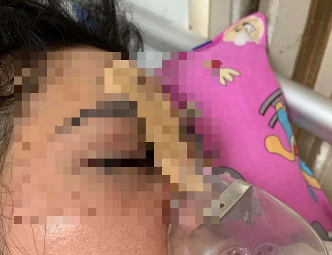 tin tuc doi song ngay 269 co gai mat thi luc mat phai sau khi tiem filler nang mui1 tin tuc doi song ngay 269 co gai mat thi luc mat phai sau khi tiem filler nang mui1