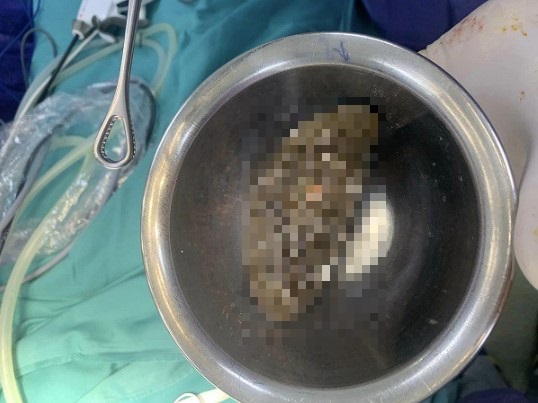 nguoi phu nu phai nhap vien phau thuat sau khi an loai qua quen thuoc nay nguoi phu nu phai nhap vien phau thuat sau khi an loai qua quen thuoc nay