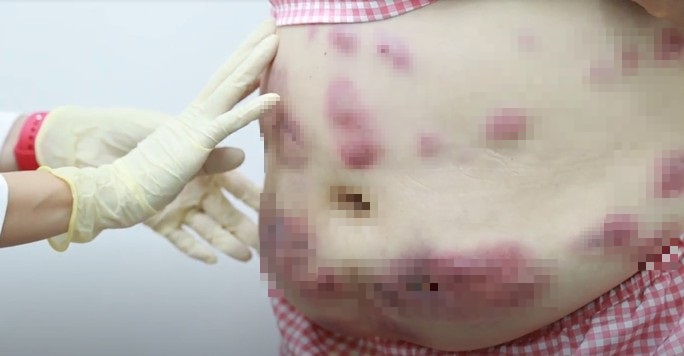 nguoi phu nu 49 tuoi bi ap xe viem chay mu sau khi tiem tan mo bung nguoi phu nu 49 tuoi bi ap xe viem chay mu sau khi tiem tan mo bung