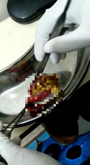 nguoi phu nu dau lung nhieu thang di kham moi biet co hon 380 vien soi trong tui mat nguoi phu nu dau lung nhieu thang di kham moi biet co hon 380 vien soi trong tui mat