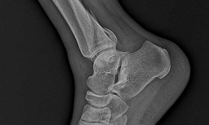 tin tuc doi song ngay 202 nguoi phu nu sung ne ban chan sau khi dap la chua gay xuong1 tin tuc doi song ngay 202 nguoi phu nu sung ne ban chan sau khi dap la chua gay xuong1