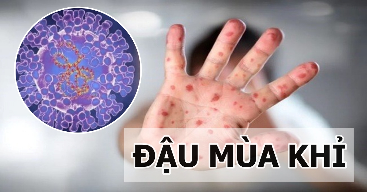 benh nhan nghi mac dau mua khi o da nang co ket qua xet nghiem am tinh benh nhan nghi mac dau mua khi o da nang co ket qua xet nghiem am tinh