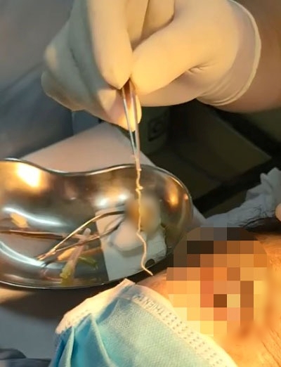 tin tuc doi song moi nhat ngay 8112023 giat minh phat hien giun dai 10 cm trong mat nguoi phu nu tin tuc doi song moi nhat ngay 8112023 giat minh phat hien giun dai 10 cm trong mat nguoi phu nu