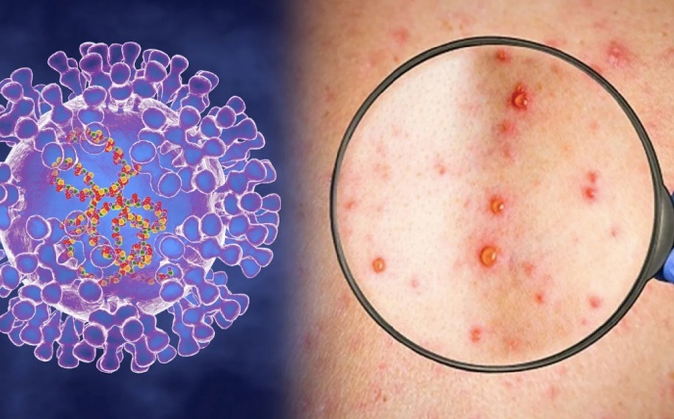 tin tuc doi song moi nhat ngay 6122023 tien giang ghi nhan truong hop mac dau mua khi dau tien tin tuc doi song moi nhat ngay 6122023 tien giang ghi nhan truong hop mac dau mua khi dau tien