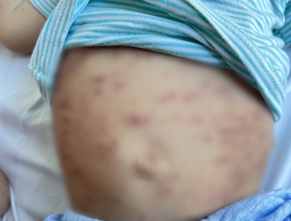 tin tuc doi song moi nhat ngay 22122023 be trai 1 tuoi mac benh hiem gap noi bong nuoc toan than