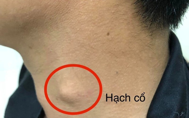 tin tuc doi song ngay 832024 can benh khien nguoi dan ong nuot nghen xuat hien hach o co tin tuc doi song ngay 832024 can benh khien nguoi dan ong nuot nghen xuat hien hach o co
