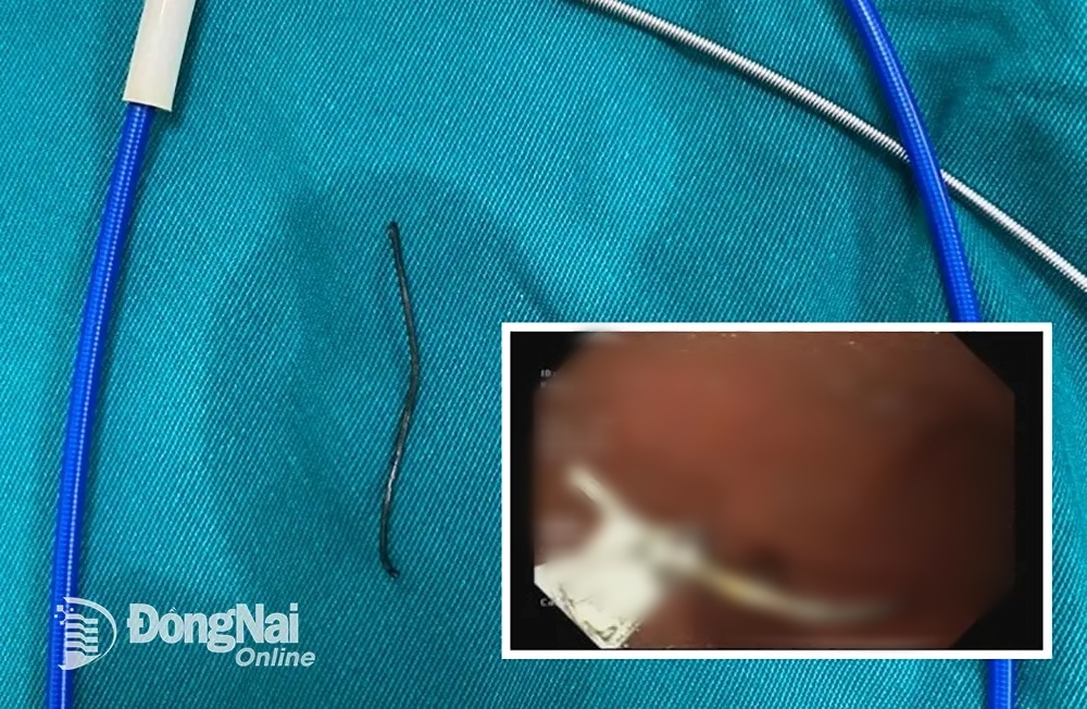 tin tuc doi song ngay 1032024 phat hien dia song dai hon 5cm trong khi quan cua nguoi dan ong1