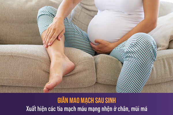 cach tri gian mao mach sau sinh 5 cach tri gian mao mach sau sinh 5