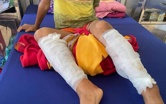 vu hoc sinh lop 3 bi cha ruot troi dung xang dot chan he lo nguyen nhan