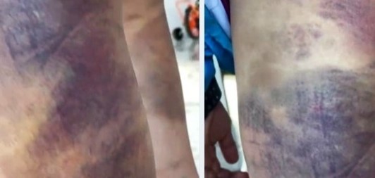 vu nam sinh lop 6 o lam dong bi ban hanh hung bam tim khap co the he lo nguyen nhan pl vu nam sinh lop 6 o lam dong bi ban hanh hung bam tim khap co the he lo nguyen nhan pl