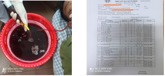 nguoi dan ong xuat huyet tieu hoa 9 lan vi nghien ruou bia nguoi dan ong xuat huyet tieu hoa 9 lan vi nghien ruou bia