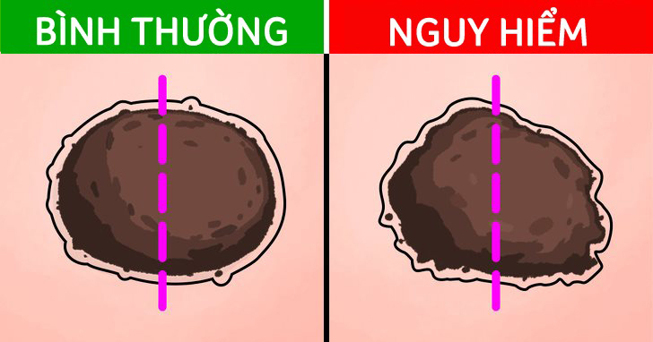 not ruoi bien dang canh bao ung thu da11 not ruoi bien dang canh bao ung thu da11