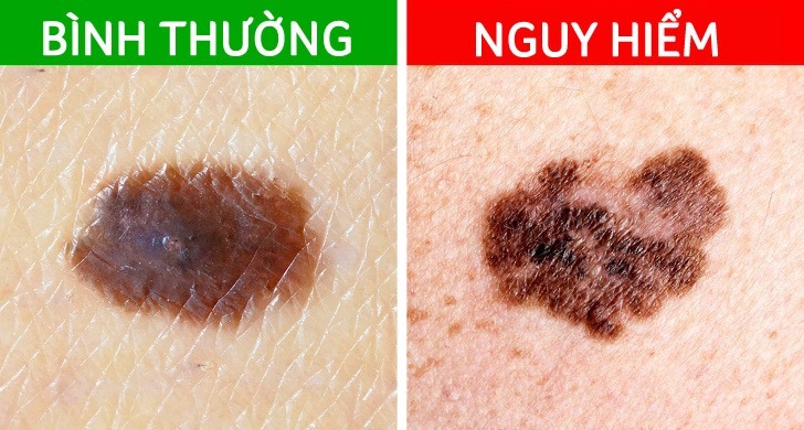 not ruoi bien dang canh bao ung thu da2 not ruoi bien dang canh bao ung thu da2