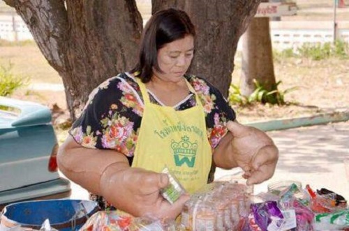 nguoi phu nu co doi tay to nhu thuy thu popeye vi benh la vo phuong cuu chua 01