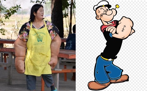 nguoi phu nu co doi tay to nhu thuy thu popeye vi benh la vo phuong cuu chua 03