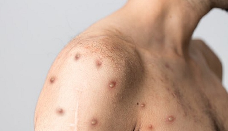 ca dau tien the gioi bi nhiem cung luc dau mua khi covid 19 va hiv 01 ca dau tien the gioi bi nhiem cung luc dau mua khi covid 19 va hiv 01